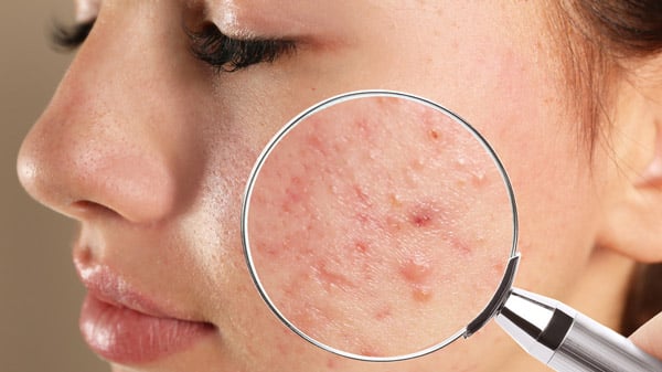 Vitamin C có tác dụng gì với da mặt? giảm mẩn đỏ và giảm viêm
